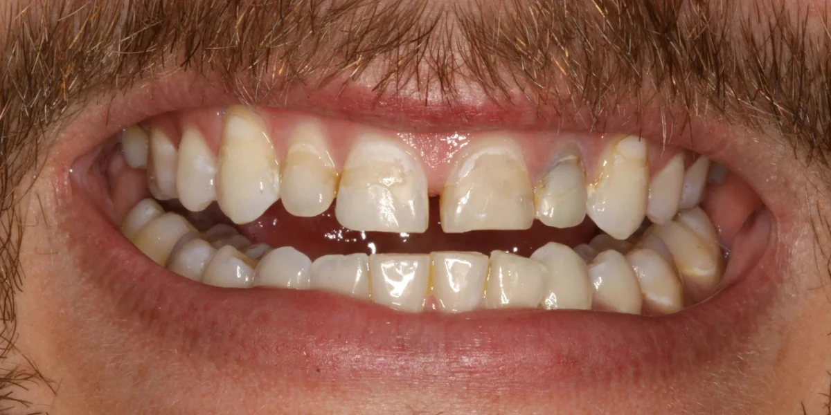 Case 9 before treatment