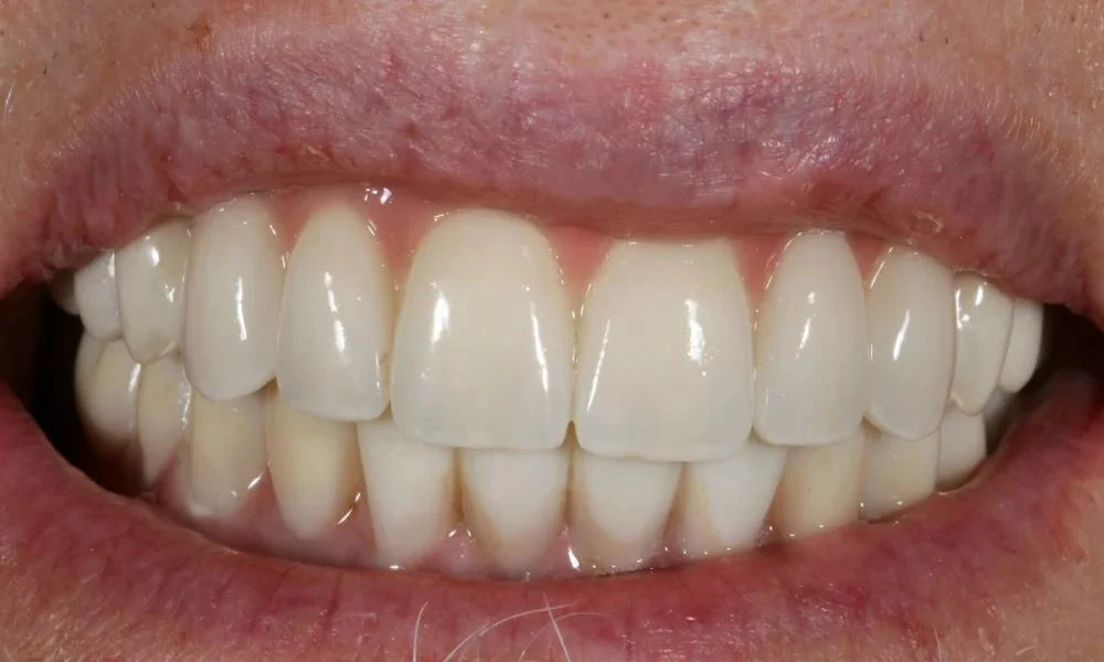 Case 11 after treatment
