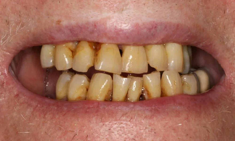 Case 13 before treatment