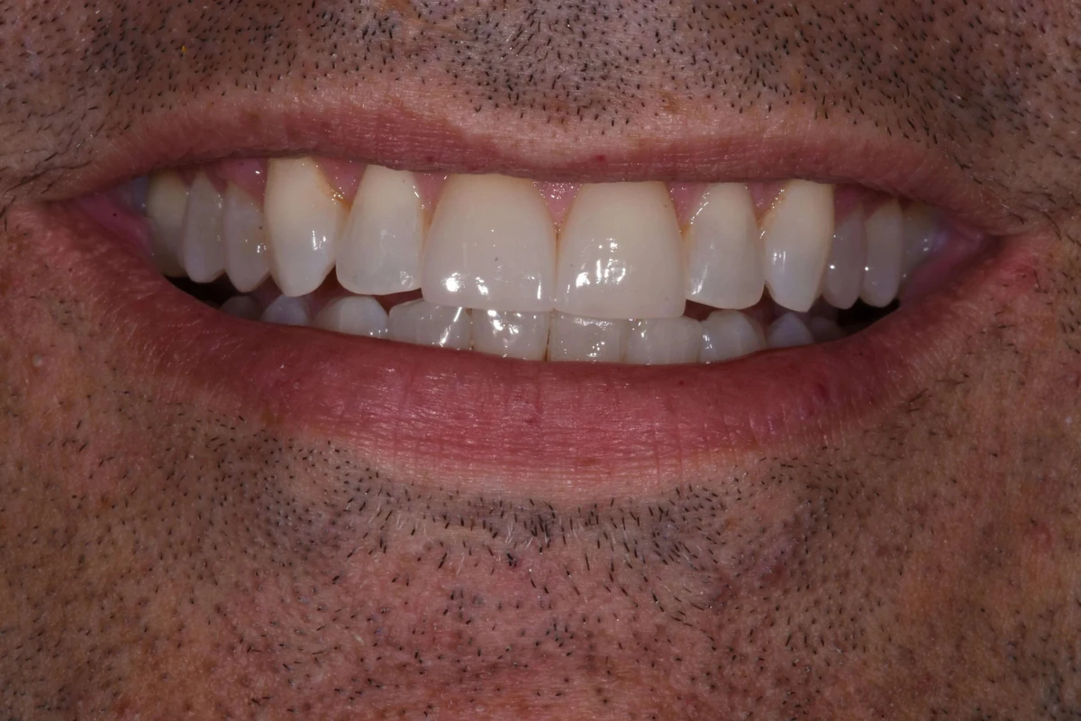 Case 14 after treatment