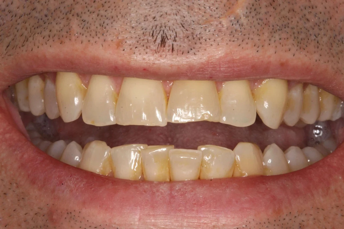 Case 14 before treatment