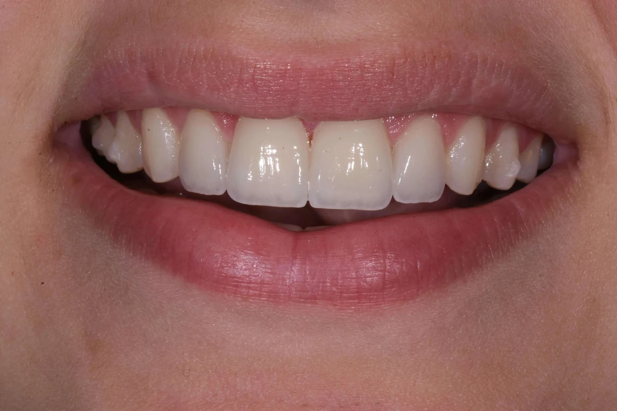 Case 17 after treatment
