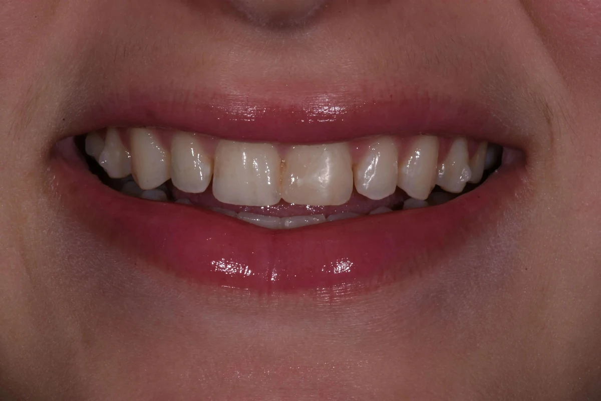 Case 17 before treatment