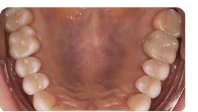 After posterior composite restorations