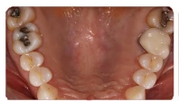 Before posterior composite restorations