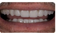 After porcelain crown restoration