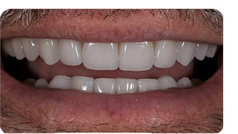 After porcelain veneers