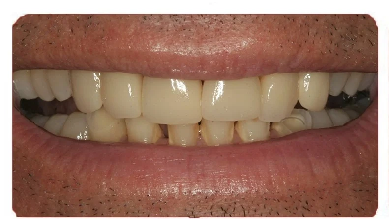 Before porcelain veneers