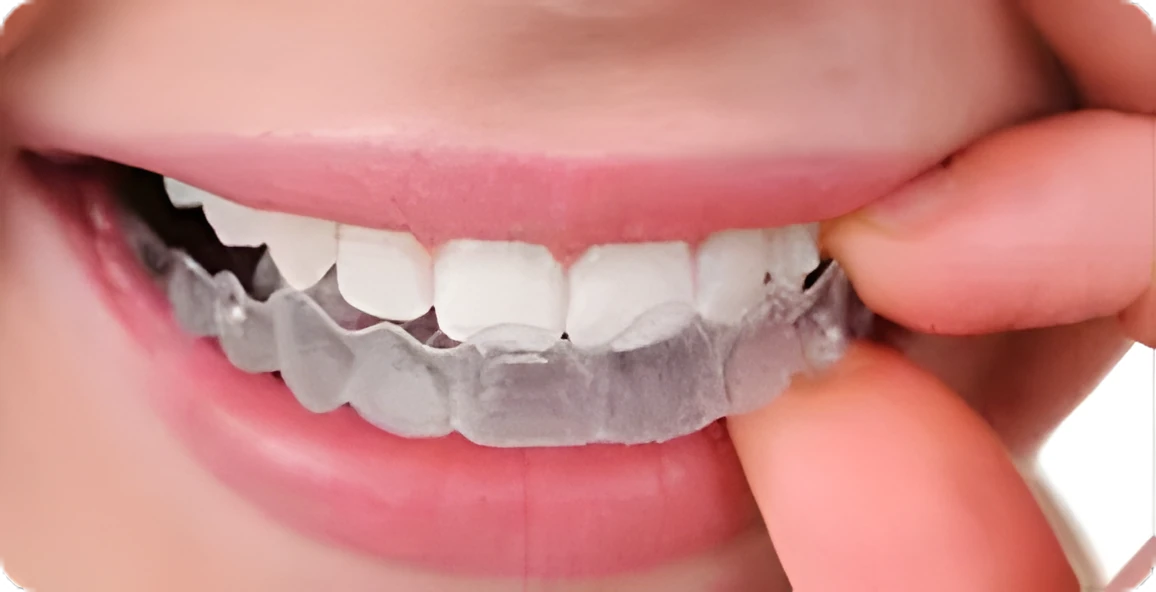 Clear aligner being fitted over teeth