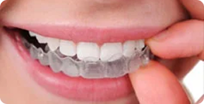 Clear aligner being fitted over teeth