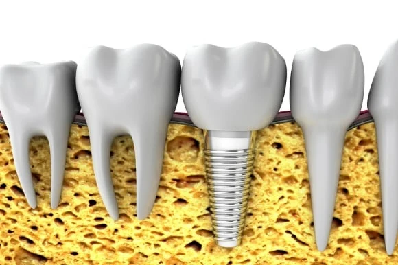 Dental implant replacing a missing tooth