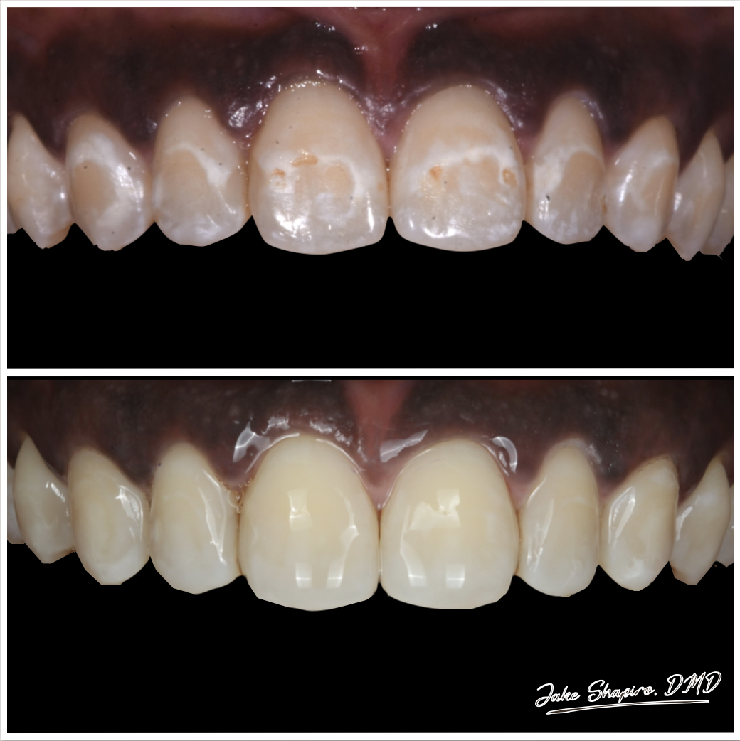 Toothaches & Dental Problems: Symptoms, Diagnosis & Treatment | iSmile Blogs 